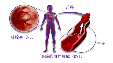 骨科术后重点关注的问题—VTE，该如何防治？
