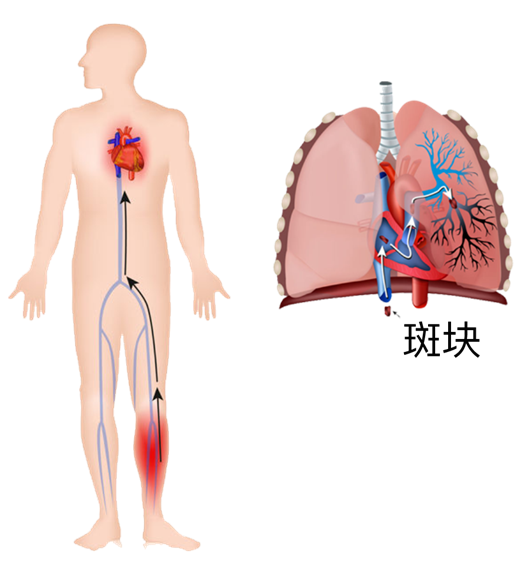 血栓是心梗、脑梗的元凶，很容易找上这些人