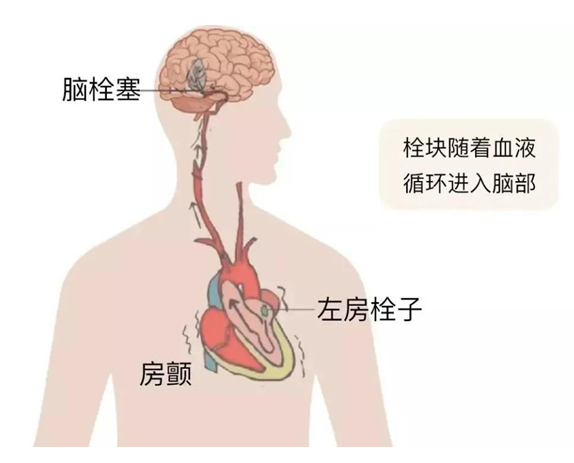血栓是心梗、脑梗的元凶，很容易找上这些人