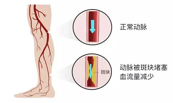 血栓是心梗、脑梗的元凶，很容易找上这些人