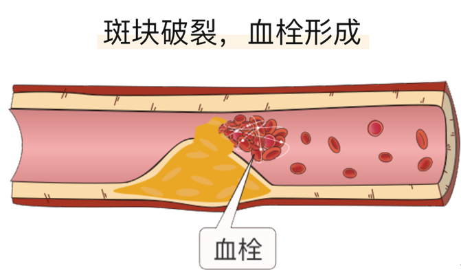 血栓是心梗、脑梗的元凶，很容易找上这些人