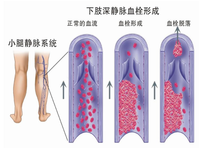 警惕！这个全球“第三大心血管杀手”，我们该如何应对？