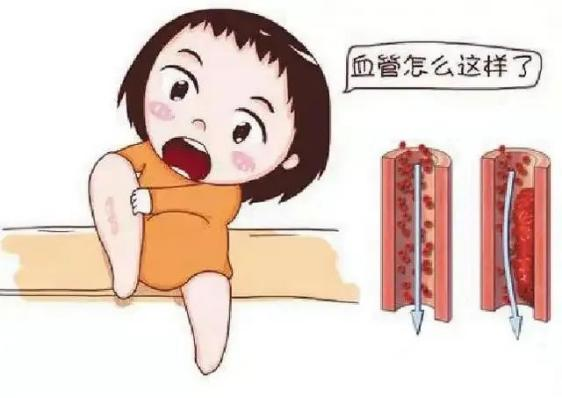 肿瘤不容忽视的第二号杀手—VTE，该如何防治？