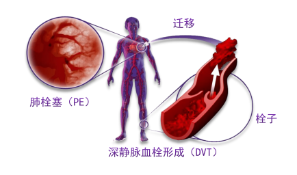 骨科术后重点关注的问题—VTE，该如何防治？