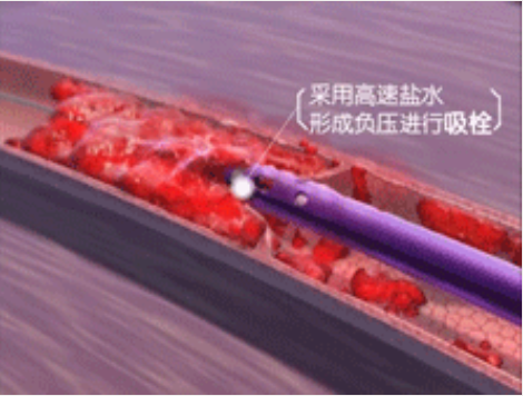 深静脉血栓能致命，防治“大法”要了解！