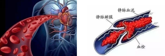 妊娠过程中的“潜伏杀手”——易栓症