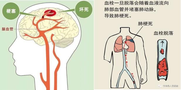 脑梗与深静脉血栓：不可忽视的血管危机